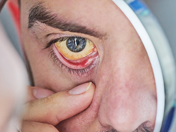 Jaundice, yellowing of the eyes and skin
